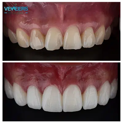 before and after teeth