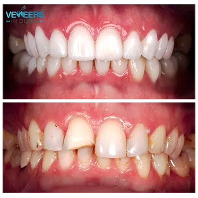 before and after veneers