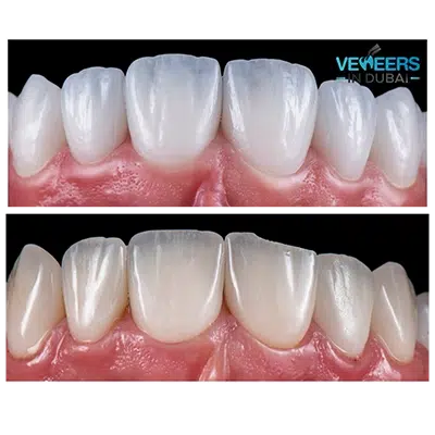 before and after porcelain