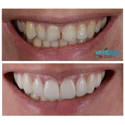 before and after Hollywood smile