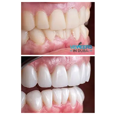 before and after veneers dubai