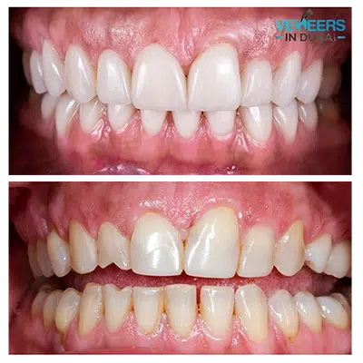 before and after amazing veneers